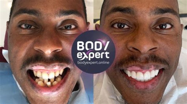 Hitman Holla Teeth; What Happened To Them?