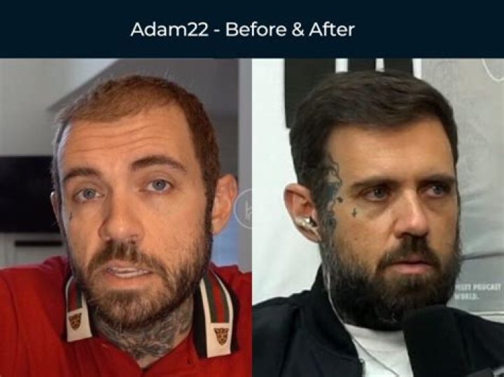 Is Adam22 Bald? Did He Have Hair Transplant? |
