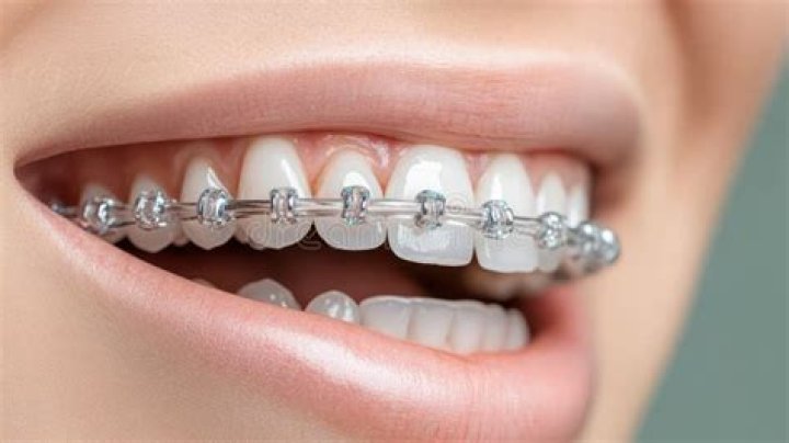 Unveiling The Journey To A Confident Grin