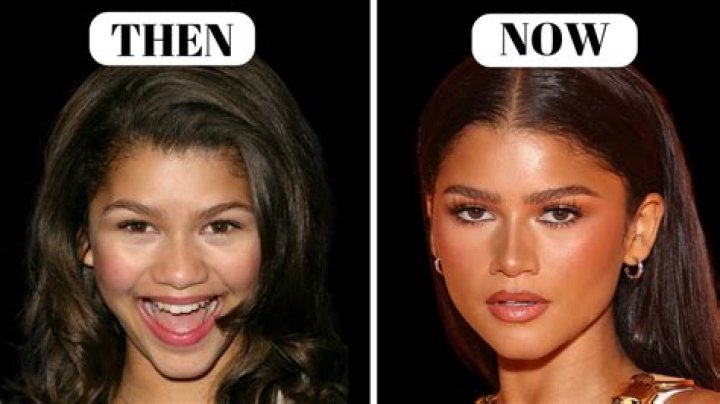 Zendaya's Plastic Surgery Journey Explored